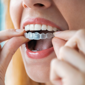 Clinica Dental Conde de Casal_Ortodoncia invisible