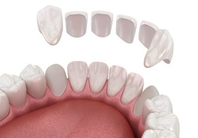 Clinica Dental Conde de Casal_Carillas dentales 10 Clinica Dental Conde de Casal_Carillas dentales 10