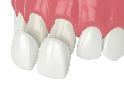 Clinica Dental Conde de Casal_Carillas dentales 11 Clinica Dental Conde de Casal_Carillas dentales 11