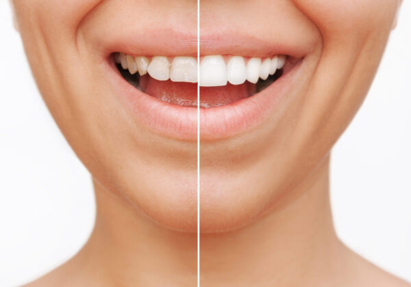 Clinica Dental Conde de Casal_Carillas dentales 13 Clinica Dental Conde de Casal_Carillas dentales 13